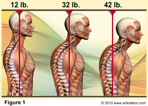 Cervical posture syndrome