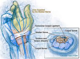 Numbness pattern of Carpal Tunnel Syndrome