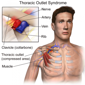 thoracic_outlet_syndrome