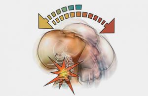 Whiplash Injury - Dr. Martin Schmaltz