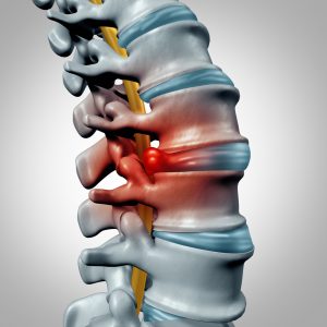 chiropractic herniated disc