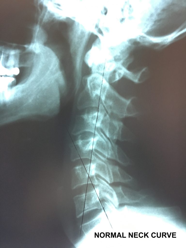 Permanent Injury From Whiplash Xray Proof Dr. Martin Schmaltz