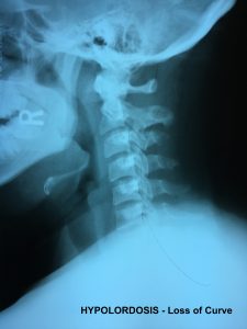 正常な首のカーブの永久的な傷害損失