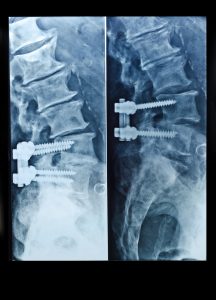 failed back surgery